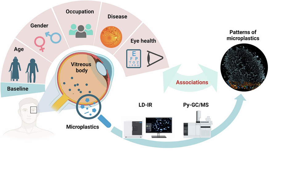 Case study about relationship between microplastics and maculopathies